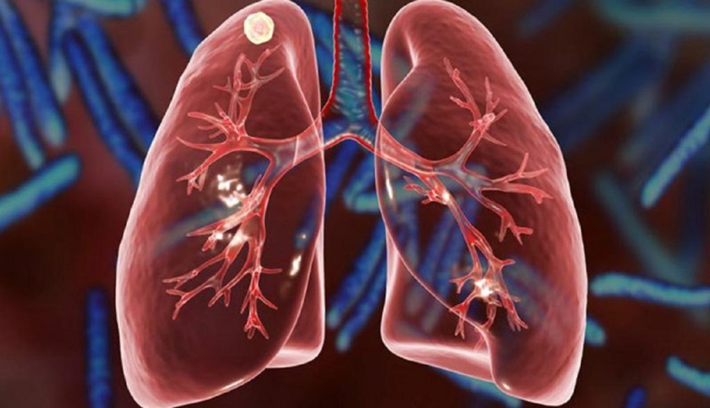 Տուբերկուլյոզն ավելի շատ կյանքեր է խլում քան մալարինան ՄԻԱՎ-ը և ՁԻԱՀ-ը